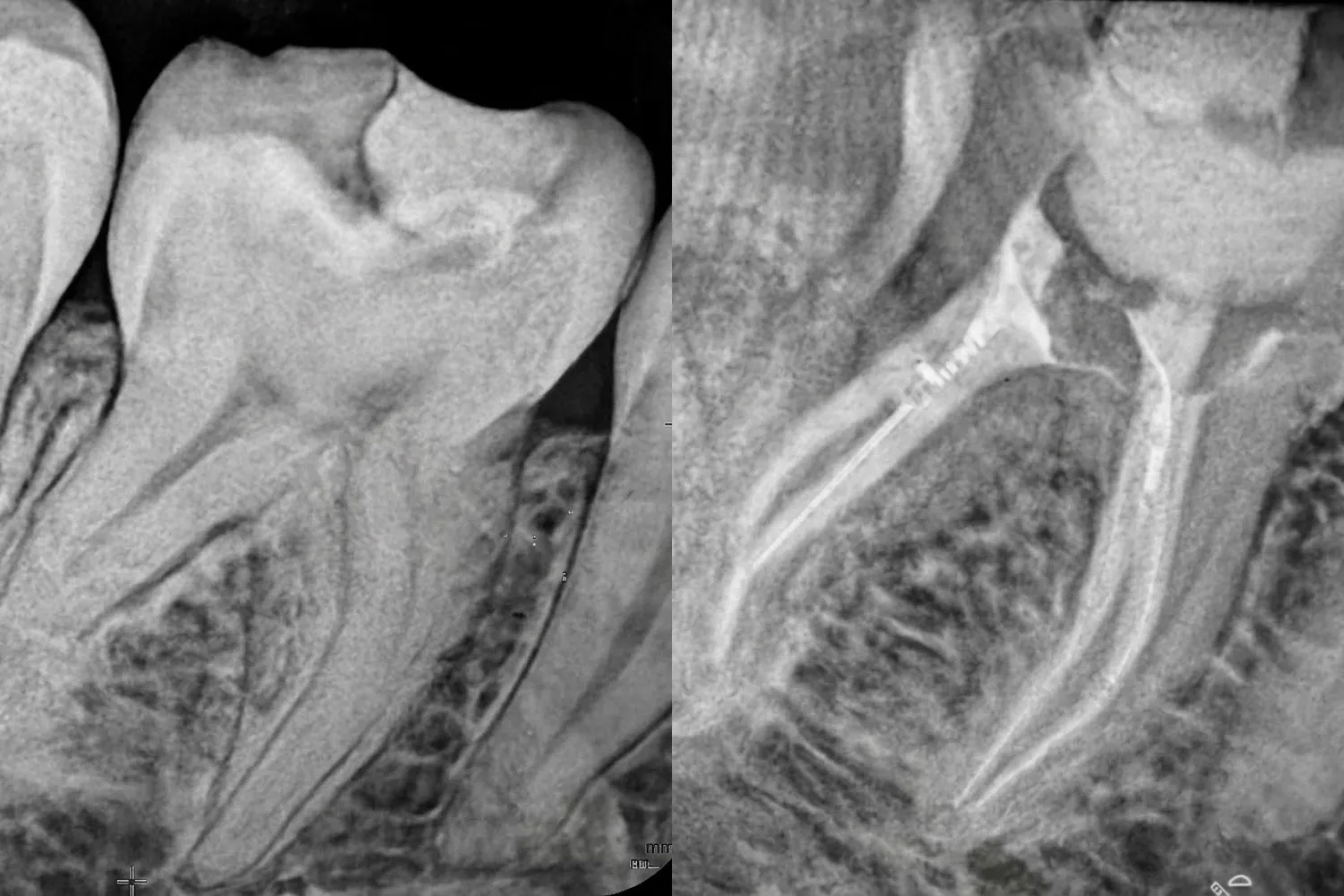 Endodoncia